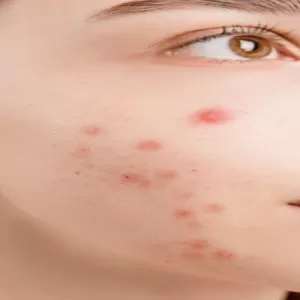 पिंपल्स के लिए सबसे अच्छा फेस वाश