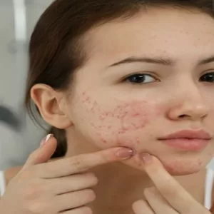 मुँहासे के लिए सबसे अच्छा फेस वाश