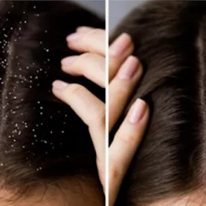 anti dandruff hair oil