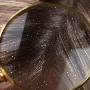 How to Get Rid of Dandruff