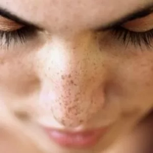 what is pigmentation