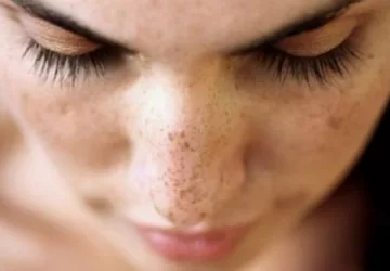 what is pigmentation