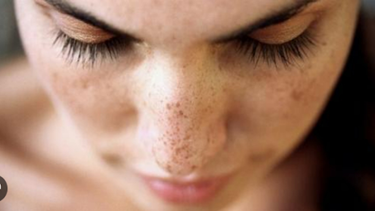What is Pigmentation? Causes, Treatments, and Embracing Your Skin