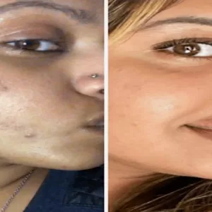 how to remove dark spots on face fast
