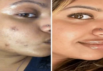 how to remove dark spots on face fast