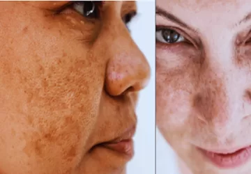 झाइयों के लिए बेस्ट फेस वाश