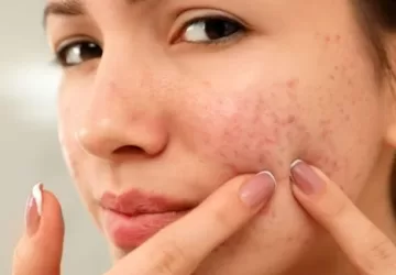 oily skin