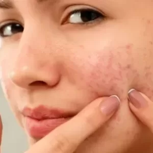 oily skin