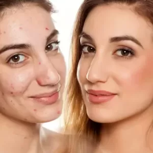 Face Par Pimple Kaise Hataye Cream