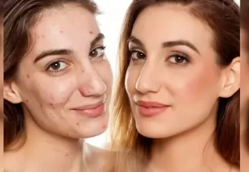 Face Par Pimple Kaise Hataye Cream