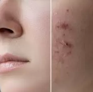 pimple k liye best cream