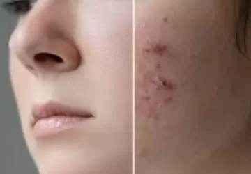 pimple k liye best cream