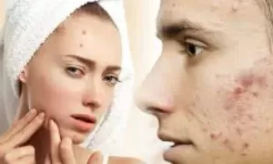 चेहरे पर कील मुंहासे