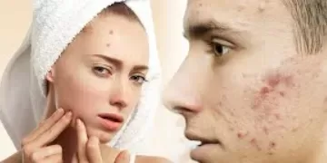 चेहरे पर कील मुंहासे