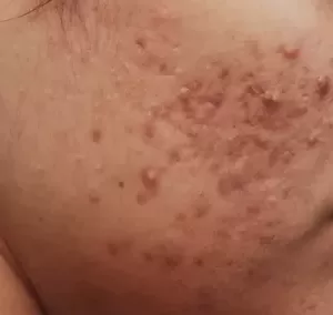 चेहरे पर फुंसी हटाने की क्रीम