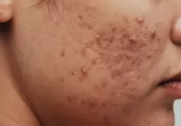 चेहरे पर फुंसी हटाने की क्रीम