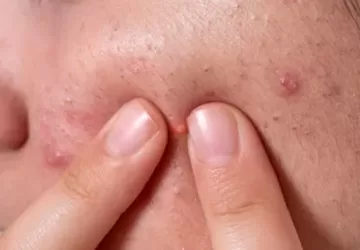 डॉक्टर पिम्पल्स