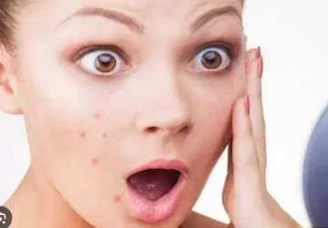 पिंपल हटाने का बेस्ट क्रीम