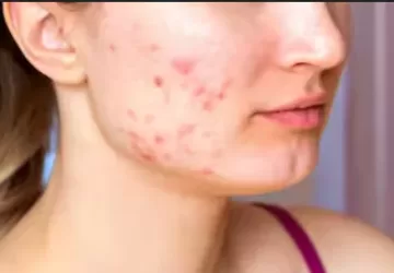 मुंहासे के दाग हटाने की बेस्ट क्रीम