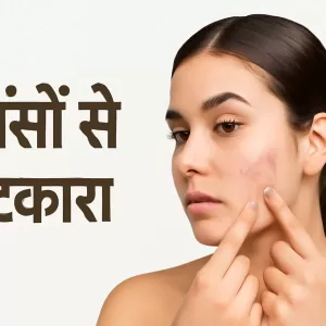 मुहांसों से छुटकारा