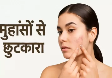 मुहांसों से छुटकारा